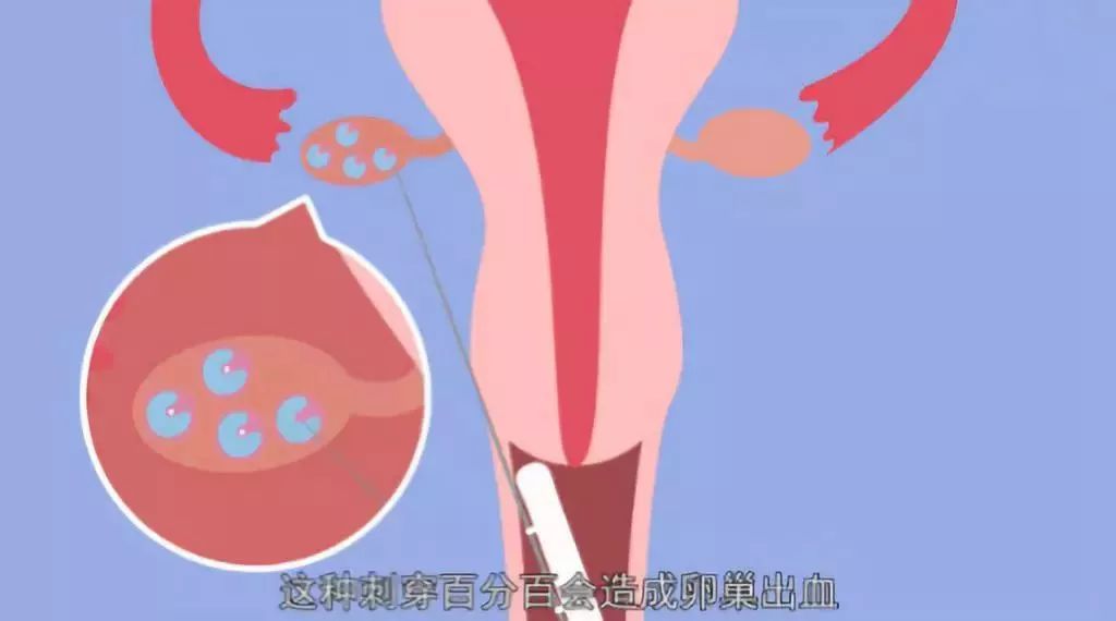 无知少女为钱卖卵,后果有多可怕你知道吗?
